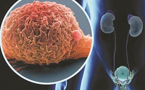 Nguy cơ gây ung thư bàng quang của thuốc Actos