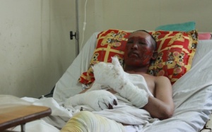 Nổ lò luyện thép, 2 công nhận bị bỏng sâu