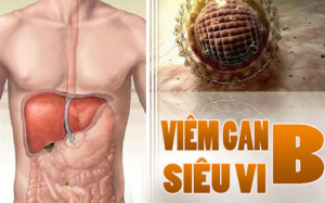 Viêm gan siêu vi B mạn tính: Âm thầm nhưng nguy hiểm tính mạng