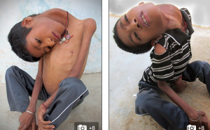 Cậu bé bị bệnh hiếm gặp: Đầu gập sang một bên