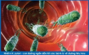 Dấu hiệu bạn bị nhiễm khuẩn H. pylori dạ dày