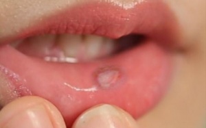 Khắc phục viêm niêm mạc miệng do thuốc trị ung thư