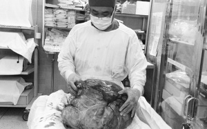 Suy kiệt vì khối bướu 26 kg trong ổ bụng