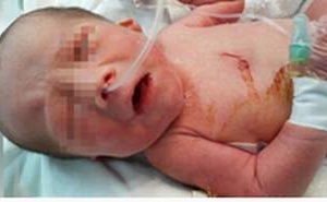 Lần đầu tiên gây mê kết hợp gây tê cho trẻ sơ sinh thiếu tháng