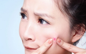 Mọc mụn do bẩn hay do cơ địa?