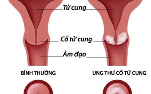 Nhận biết ung thư cổ tử cung