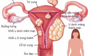 U xơ tử cung: Phát hiện muộn là vô sinh!