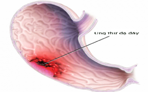 Ung thư dạ dày: Ai dễ mắc?