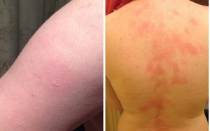 Dị ứng với cả nụ hôn của chồng