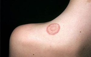 Những bệnh ngoài da dễ mắc vào mùa hè