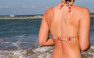 Mẹo phục hồi da cháy nắng sau đi biển