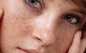 Nám da: “Sát thủ” của sắc đẹp