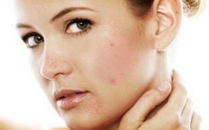 Bị viêm da tiết bã nhờn nên dùng thuốc gì?