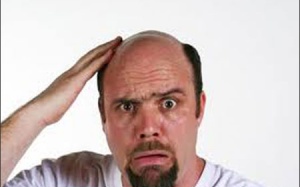 5 lưu ý phòng chứng hói đầu ở nam giới