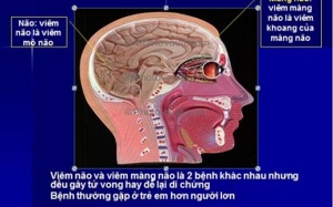 Bệnh viêm màng não gia tăng
