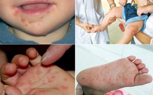 Bộ Y tế khuyến cáo phòng chống bệnh tay chân miệng