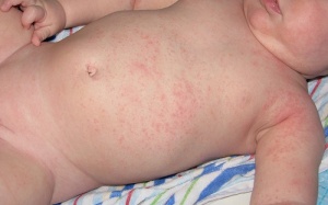 Cách trị rôm sảy hiệu quả cho bé mùa nắng nóng