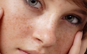 Thổi bay tàn nhang nhờ bí xanh và mướp đắng