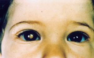 Cậu bé được phát hiện ung thư mắt nhờ bức ảnh mẹ chụp