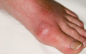 Khớp ngón chân cái sưng đỏ có thể nghĩ đến bệnh gout