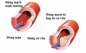 Tư vấn miễn phí “Xơ vữa động mạch cảnh – Bệnh chết người, bác sỹ dễ quên”