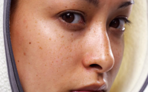 Ôi… tàn nhang!!!