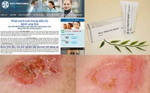 Chỉ xoa kem là hết ung thư vú (?!)