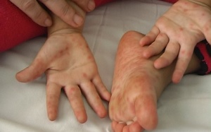 Lâm Đồng: Bé gái 3 tuổi tử vong vì bệnh tay chân miệng