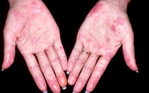 10 biện pháp tự nhiên giúp giảm triệu chứng lupus (P.1)