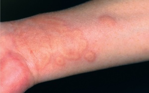 Bệnh nổi mề đay trị dứt điểm như thế nào?