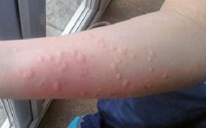 Mề đay lạnh - Căn bệnh không chỉ riêng mùa Đông