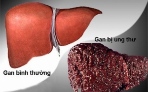 Những người nào dễ mắc bệnh ung thư gan?