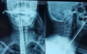 Suýt chết vì dùng xẻng nấu ăn thông cổ họng