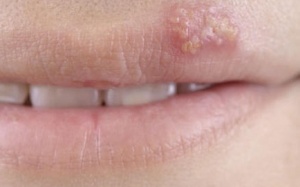 Biến đổi virus herpes thành vaccine điều trị ung thư da