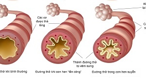 Thuốc chữa hen nào an toàn cho thai nhi?