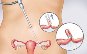 Đặt vòng tránh thai - Cẩn thận kẻo... vô sinh!