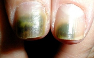 Móng tay màu xanh là bệnh gì?