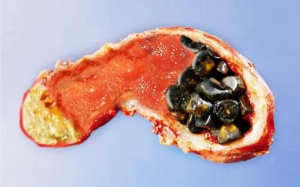 Bị sỏi mật do thói quen ăn uống