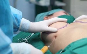 Bơm ngực bằng mỡ tự thân: Liệu có an toàn?
