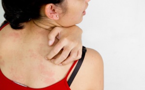 Phương pháp thiên nhiên chữa dị ứng da hiệu quả