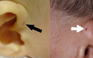 Cẩn trọng với bệnh dò luân nhĩ ở trẻ sơ sinh