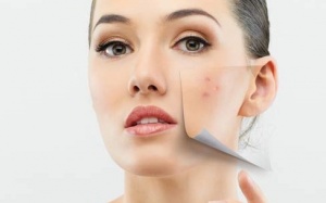 Loại bỏ mụn do dị ứng mỹ phẩm