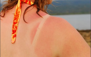 Những điều cần làm khi bị cháy nắng