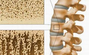 Cách thức mới điều trị loãng xương