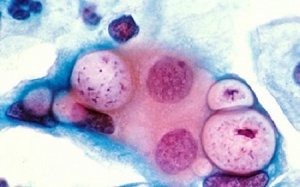 Vì đâu chị em bị vô sinh?