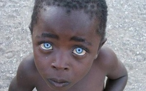 Người kỳ quái hai đồng tử trong một mắt