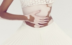 Một số phương pháp tự nhiên điều trị bạch biến