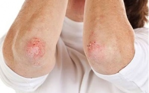 Mùa hè cẩn trọng với các bệnh về da