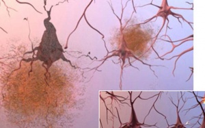 Tổn hại não đáng sợ do thiếu ngủ