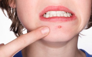 Chữa mụn nhọt như thế nào?